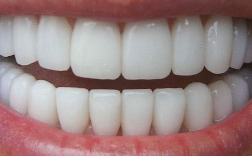 Teeth Whitening